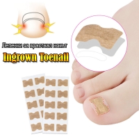 Лепенки за врастнал нокът Ingrown Toenail комплект от 50 броя